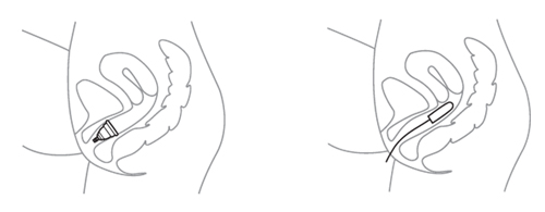 menstruační kalíšek